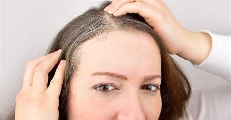 Mole on Scalp: Types of Moles, Risks, and Warning Signs of Melanoma