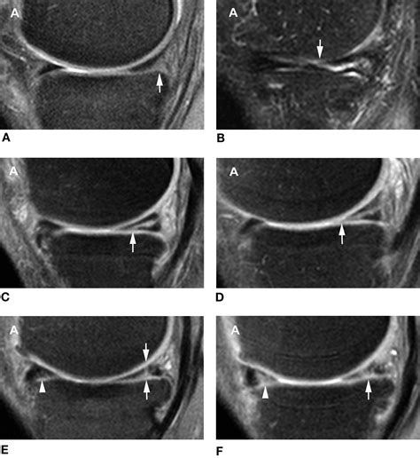 Medial Meniscus Tear Mri