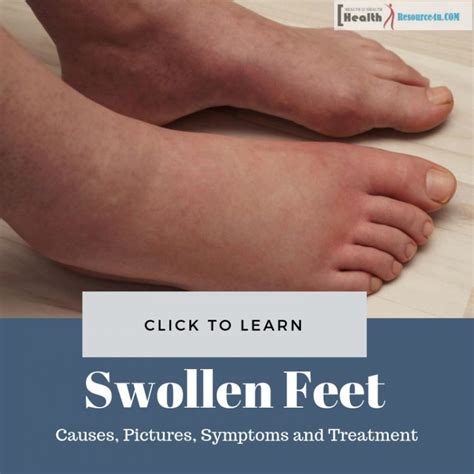 Swollen Feet : Causes, Pictures, Symptoms And Treatment