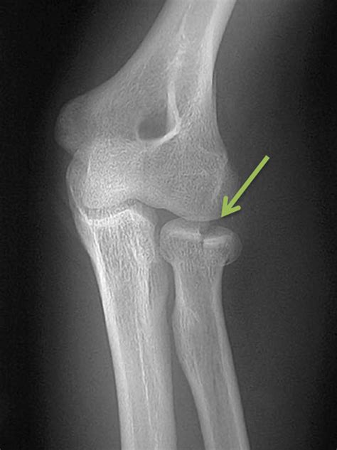 Radial Head Fractures