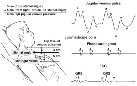 Jugular Venous Pulse and Pressure (JVP) Examination | Epomedicine