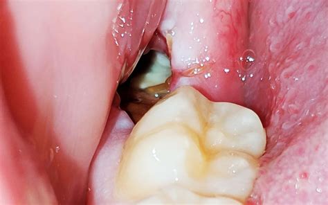 How Should My Wisdom Tooth Extraction Look