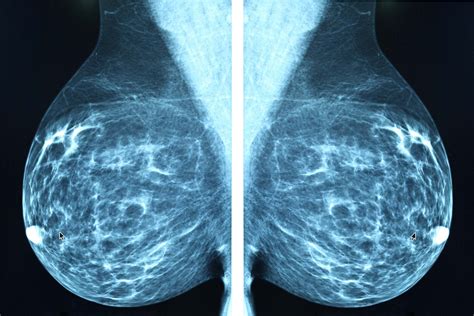 Abnormal Mammogram: Questions to Ask | Reader's Digest