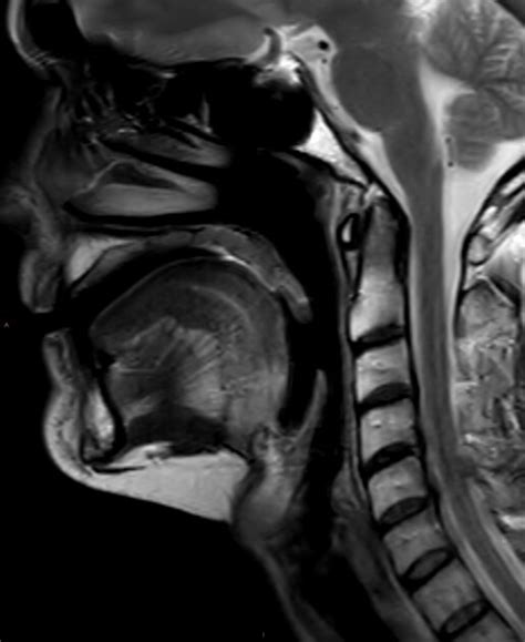 Mri Of Head And Neck