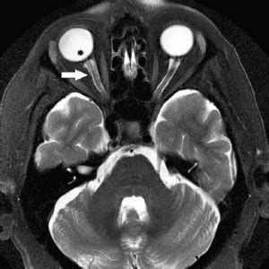 Otolaryngologists Play Key Role in Management of Idiopathic ...