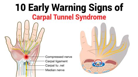 Carpal tunnel syndrome - hetyplant