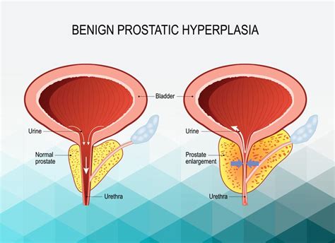 What is BPH? | Advanced Urology Associates