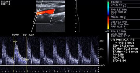 Carotid Artery Ultrasound