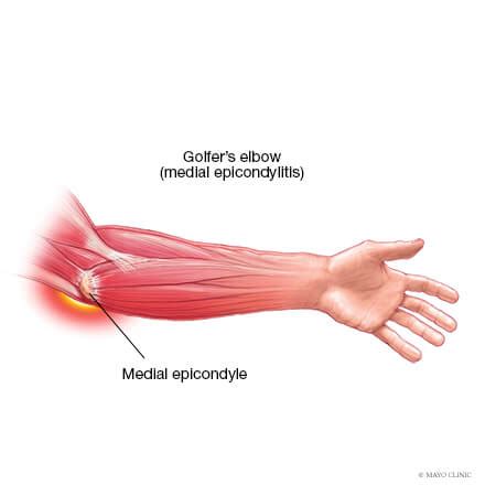 Golfer’s Elbow (Medial Epicondylitis) - Overview - Mayo Clinic ...