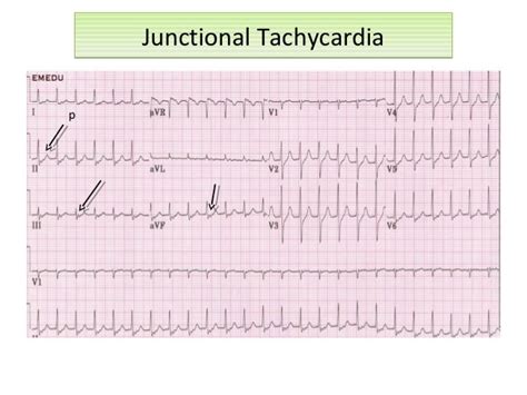 Junctional Tachycardia Vs Svt - Merryheyn