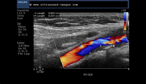 Ultrasound imaging: Carotid artery atherosclerotic plaques- moderate ...