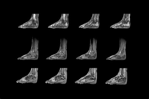 Charcot Arthropathy, Mri Scans Photograph by Zephyr