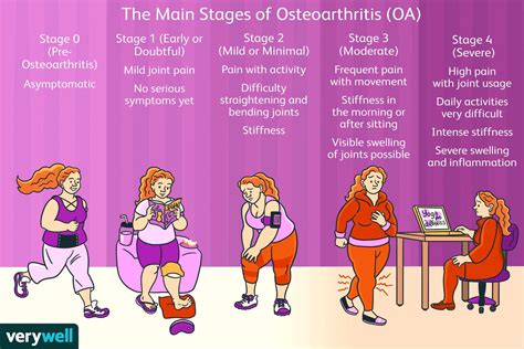 The 4 Stages of Osteoarthritis: Symptoms and Treatment