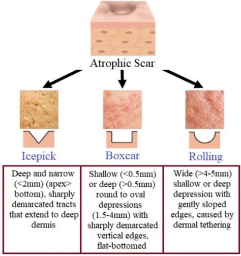 Three different types of atrophic scars based on width, depth, and ...