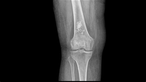 Chondrosarcoma X Ray - wikidoc