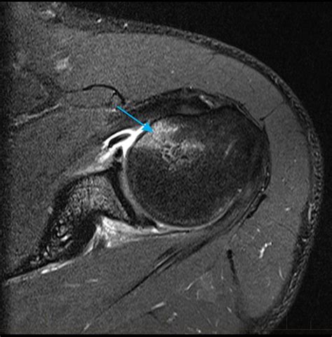 MRI Shoulder - Musculoskeletal Imaging