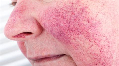 How Different Rosacea Types Are Treated, According to a Derm - GoodRx