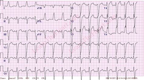 Left Atrial Enlargement ECG (Example 2) | Learn the Heart