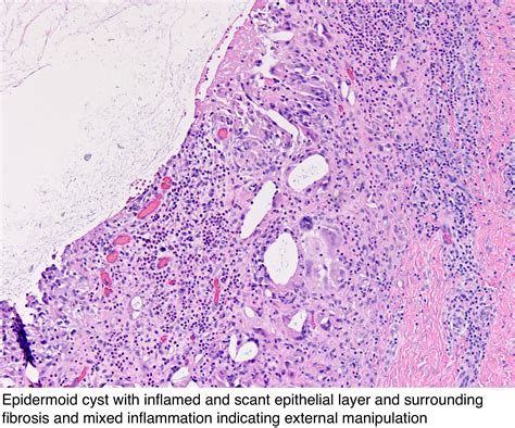 Pathology Outlines - Epidermal (epidermoid) type