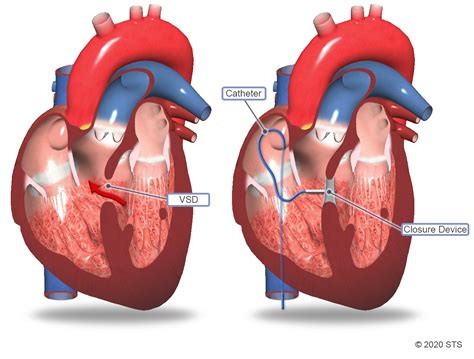 Ventricular Septal Defect Surgery | The Patient Guide to Heart, Lung ...