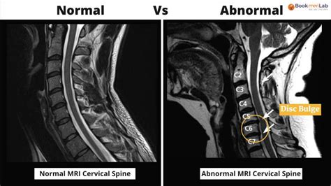 MRI Cervical spine Price, Purpose & Result [2025]