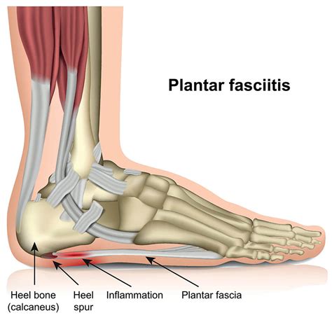 Plantar Fasciitis Treatment Shoes Store | bellvalefarms.com