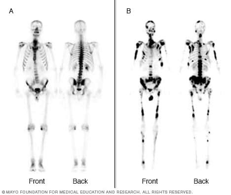 Bone scan - Mayo Clinic