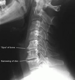 Arthritis and degeneration in the spine - Ridiculously Well