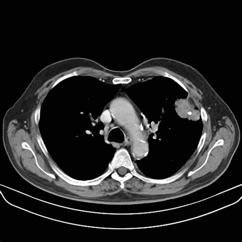 Lung mass imaging - wikidoc