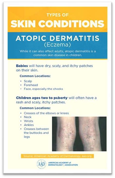 Atopic Dermatitis/Eczema: Diagnosis and Treatment - Dermatology Surgery ...