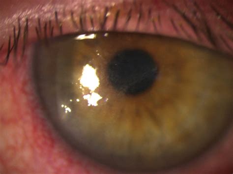 Herpes Simplex Keratitis: Managing the Masquerader