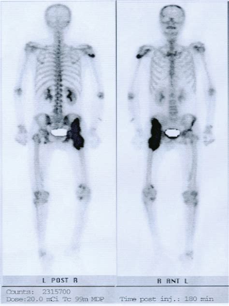 Triple-phase bone scan of the posterior (left) and anterior (right ...