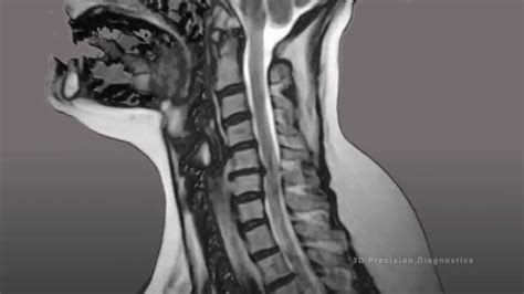 Mri Cervical Spine Neck Pain