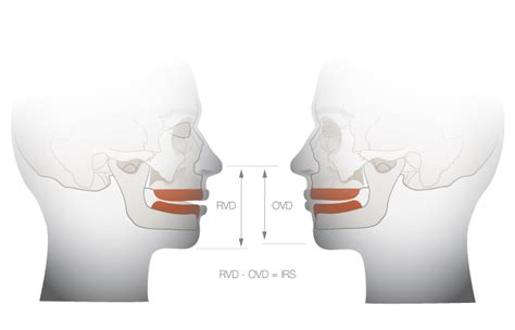 Vertical dimension | Treatment Guidelines | FOR.org