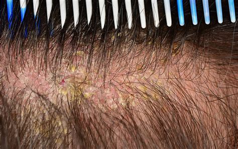 Scalp Eczema: Causes, Symptoms, Treatments & Preventive Tips – Vedix