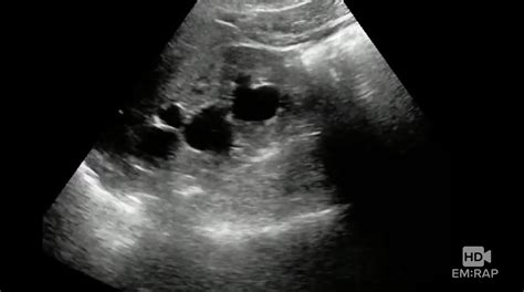 HD - Ultrasound of Hydronephrosis | EM:RAP