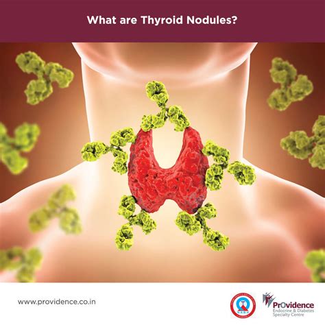 What are Thyroid Nodules? | Thyroid Nodule Causes and Symptoms