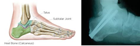 Royal Orthopaedic Hospital - Subtalar Joint Fusion