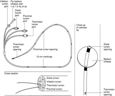 Pulmonary Artery Catheter Placement