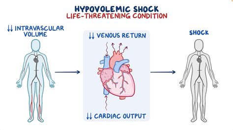 Hypovolemic shock: Clinical sciences - Osmosis Video Library