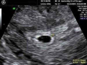 Ultrasound 5 Weeks Pregnancy