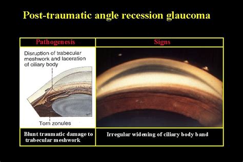 SECONDARY GLAUCOMAS 1 Pseudoexfoliation glaucoma 2 Pigmentary glaucoma