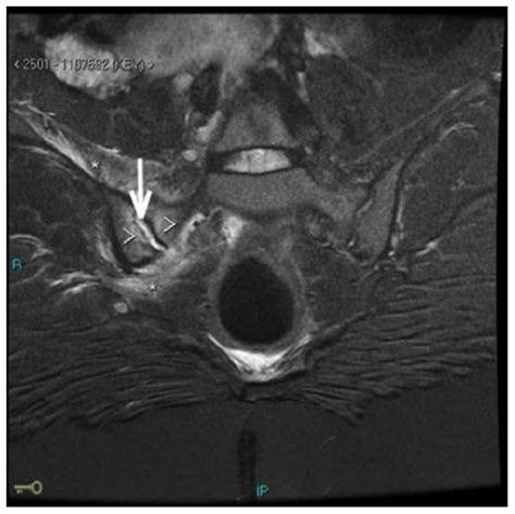 Pelvic MRI on admission showing bone marrow edema (arrowheads), small ...