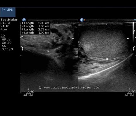 Ultrasound and Color Doppler videos: Inguinoscrotal hernia -ultrasound ...