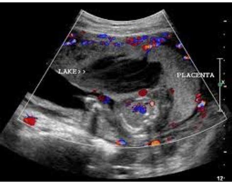 Placental lake | Placental, Ultrasound, Lake