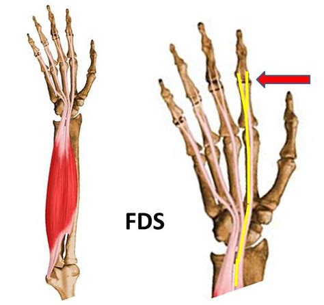 Flexor Tendon Injuries