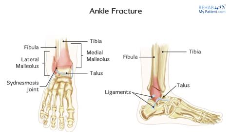 Ankle Fracture | Rehab My Patient