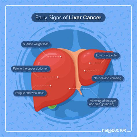 Stages of Liver Cancer: What Happens In Stages 1 - 4?