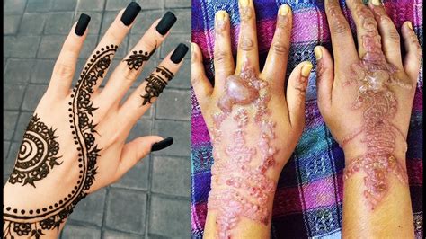 Temporary Black Henna Tattoos Can Be Painfully Permanent - YouTube