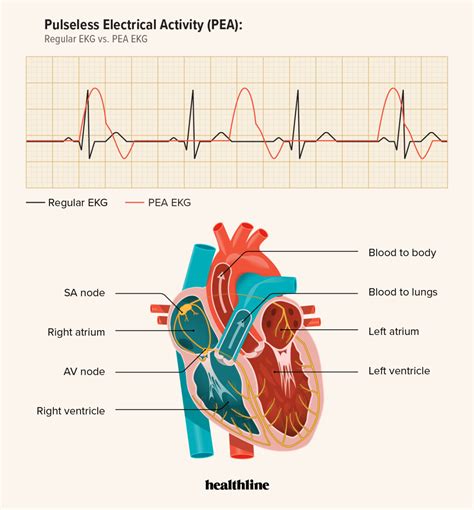 Pulseless Electrical Activity (PEA): Causes, Diagnosis, Treatment